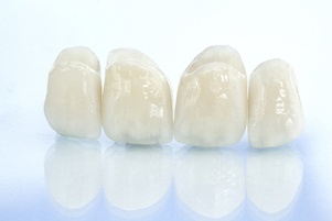 dental bridge