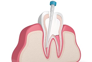 Root canal cleaning procedure graphic