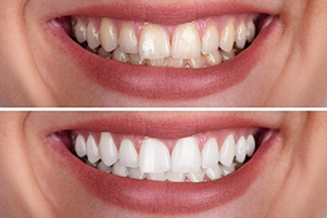 before and after teeth whitening