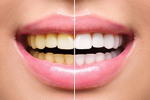 teeth whitening
