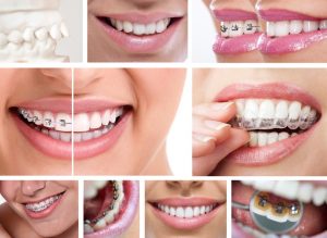 David A. Tripulas DDS offers orthodontics in Wharton with Fastbraces and Invisalign. These braces appeal to patients with mild to medium smile issues.