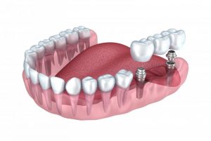 dental implants
