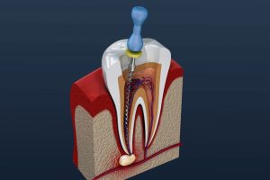 Digital model of a root canal in Wharton